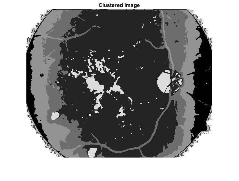 Early Detection of Diabetic Retinopathy Edema
using FCM