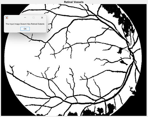 Early Detection of Diabetic Retinopathy Edema
using FCM