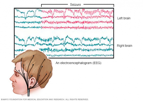 پردازش سيگنال هاي الكتروآنسفالوگرافي به منظور تشخيص انواع تشنجات صرعي پتي مال وگراندمال با استفاده از شبكه هاي عصبي مصنوعي
